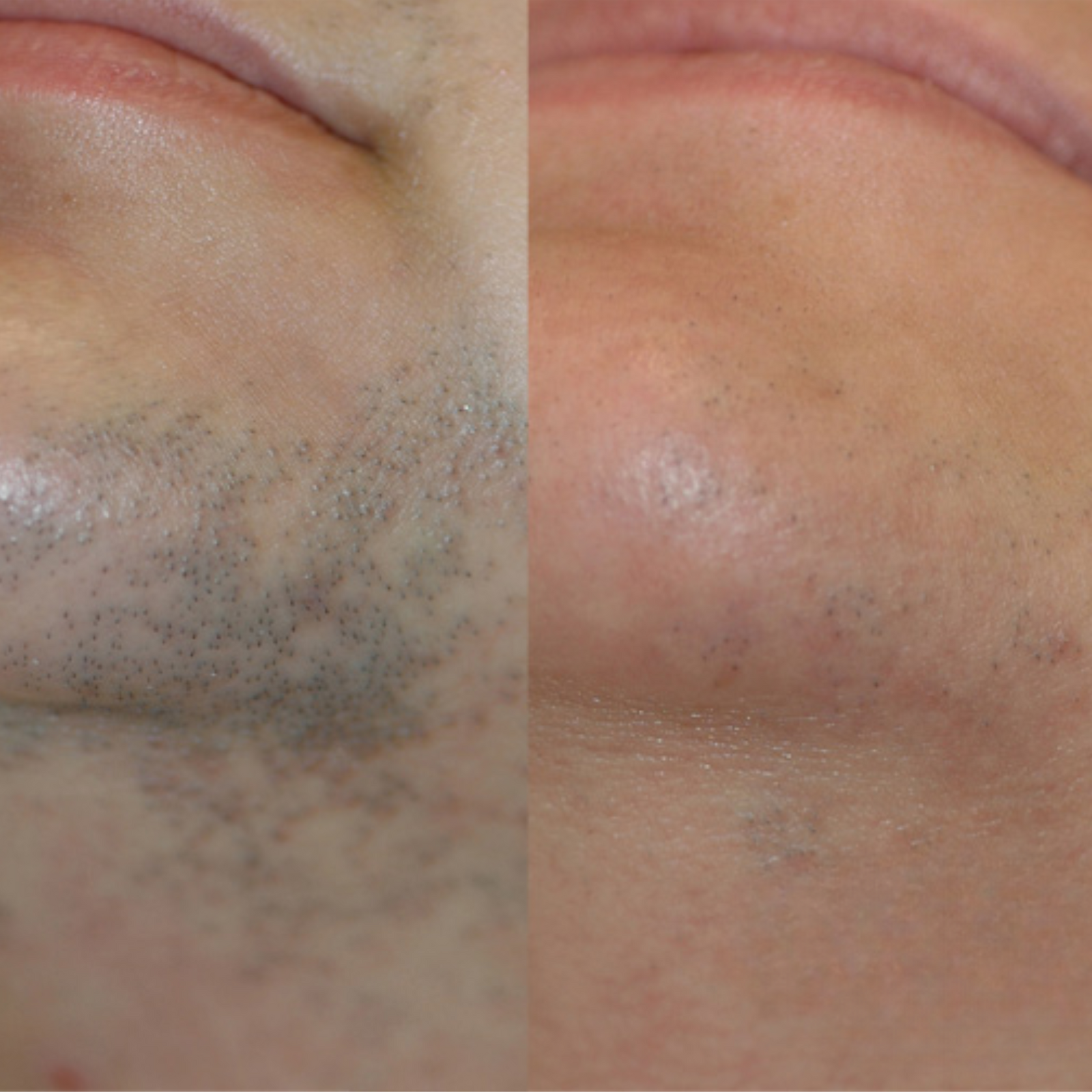 2. Coarse Stubble Becomes Soft and Fine